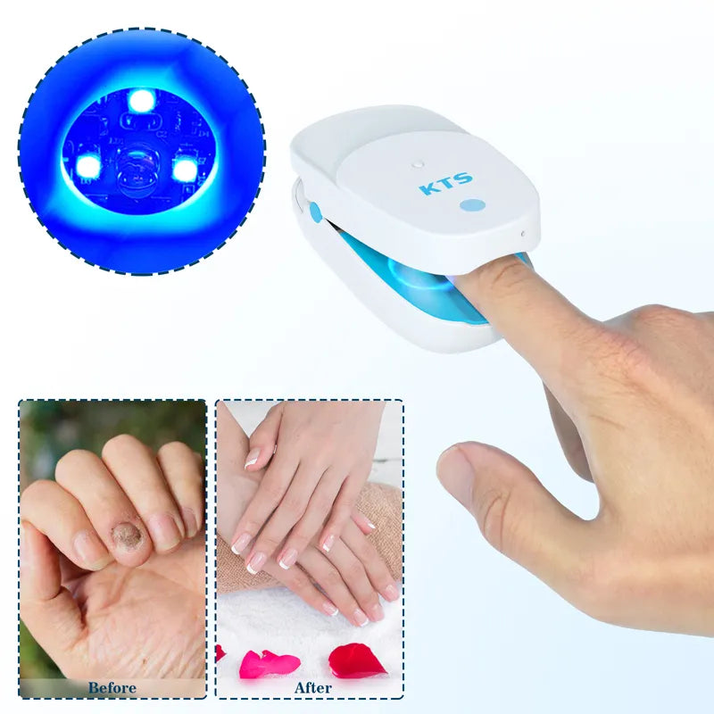 Fungal Nail Treatment Laser Device For Nail Fungus 905nm 470nm Fungus Nail Removal Anti Infection Paronychia Onychomycosis Care
