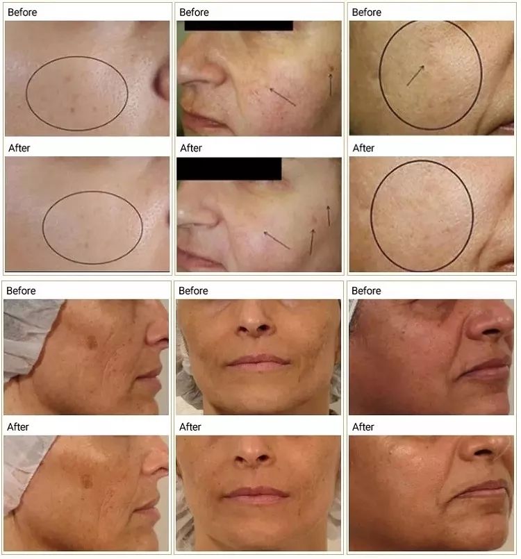 NEW Arrivals 3 in 1 Set CO2 Oxygen Bubble Machine Facial Massage Oxygenation RF Therapy Super Facial Whitening Rejuvenation Anti-Aging System Face Lifting Tightening Machine