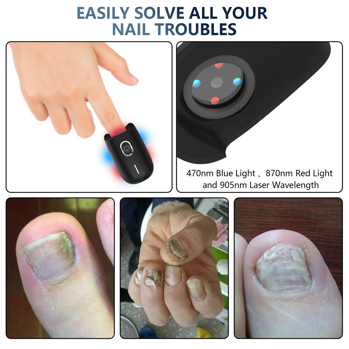 KTS Nail Fungus Laser Device Toenail Laser Therapy Machine Anti Fungal Laser Equipment for Onychomycosis 910nm 407nm USB Charge
