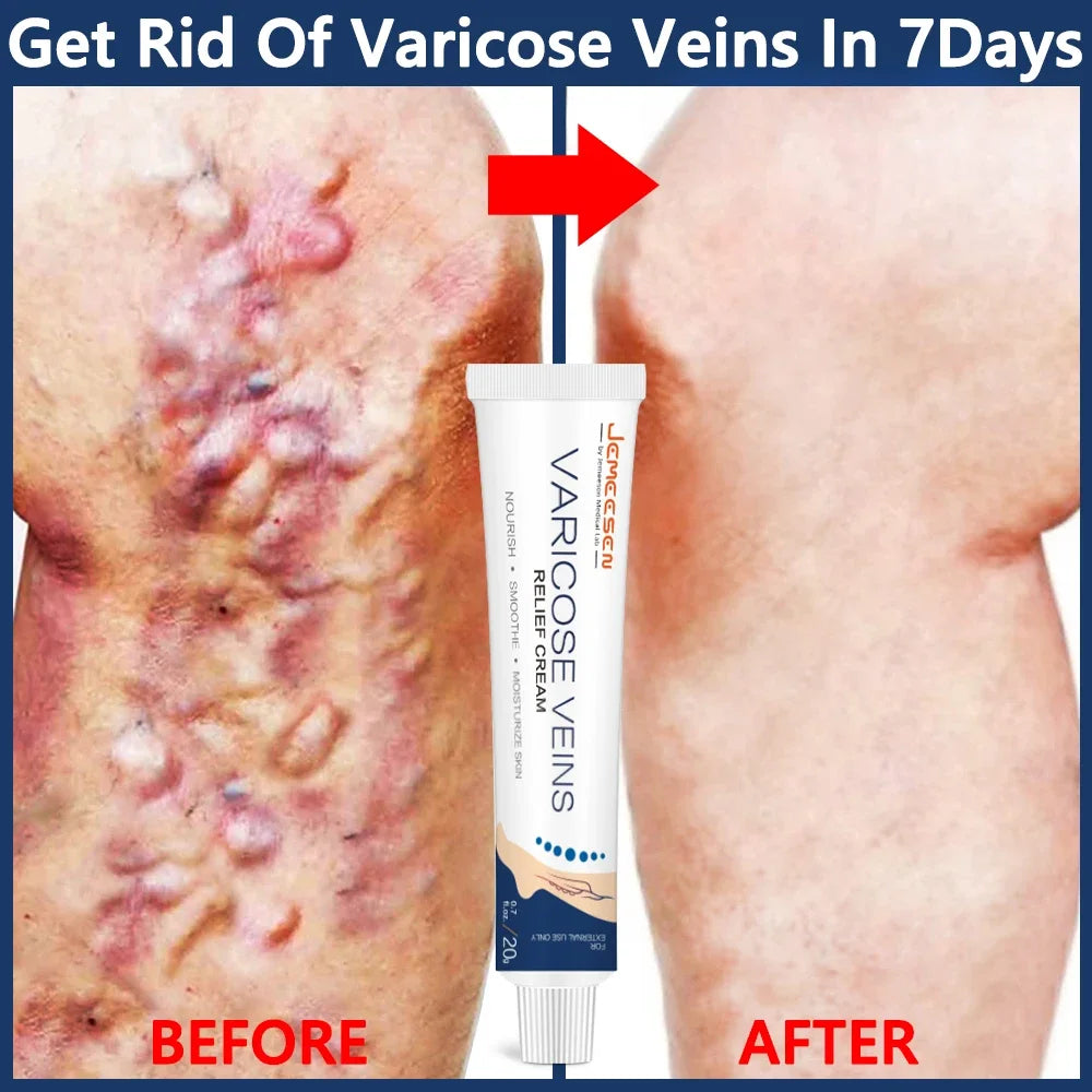 Jemeesen Potent Varicose Veins Relief Cream Leg Vasculitis Phlebitis Spider Shape Vein Pain Relief Ointment Angiitis Removal