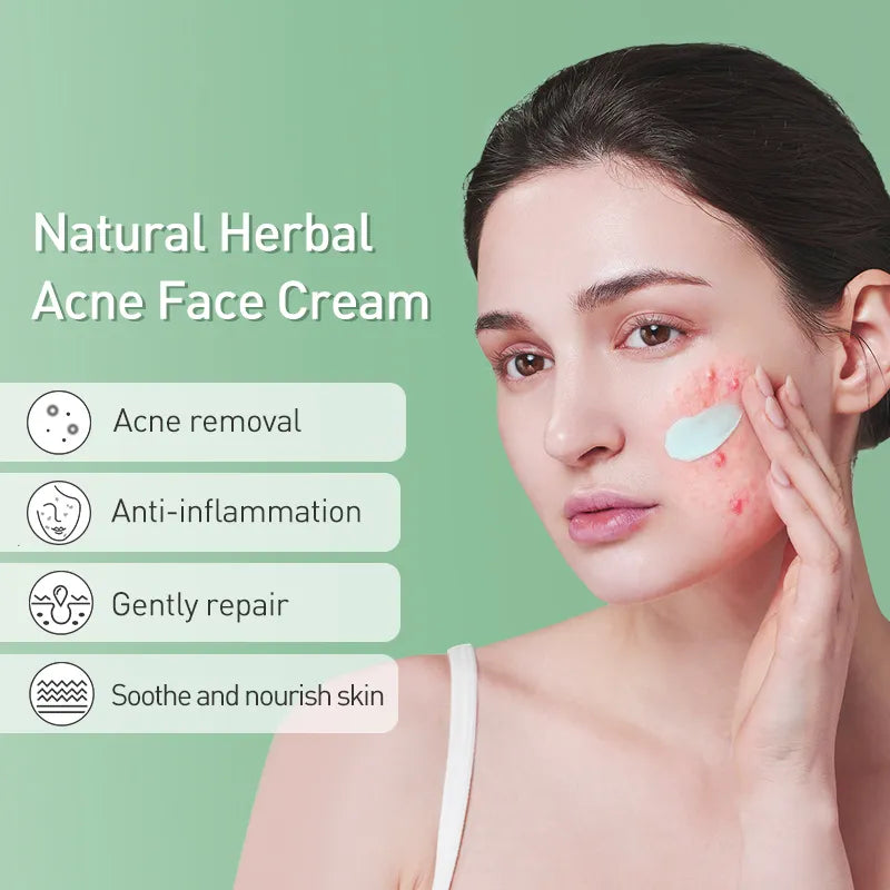 JoyPretty Herbal Acne Removal Face Cream Pimple Scar Treatment Moisturize Shrink Pore Acne Facial Cream Korean Skin Care Product