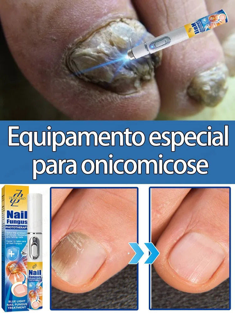 Laser Foot Nails Sterilization Onychomycosis Disinfection Therapy Treatment Armor Heart Cure Laser Device Set