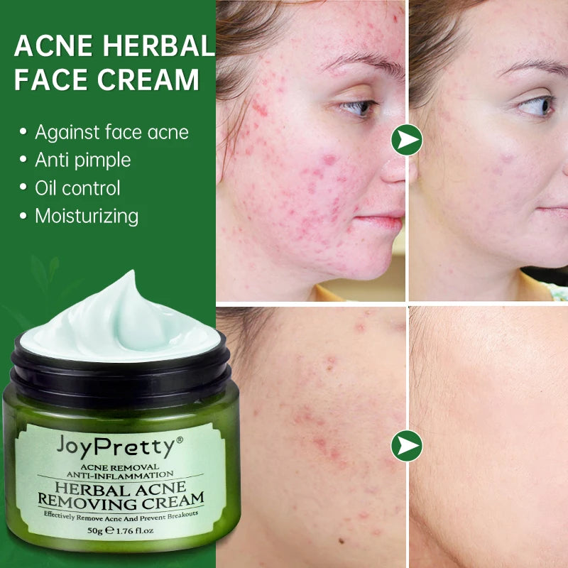JoyPretty Herbal Acne Removal Face Cream Pimple Scar Treatment Moisturize Shrink Pore Acne Facial Cream Korean Skin Care Product