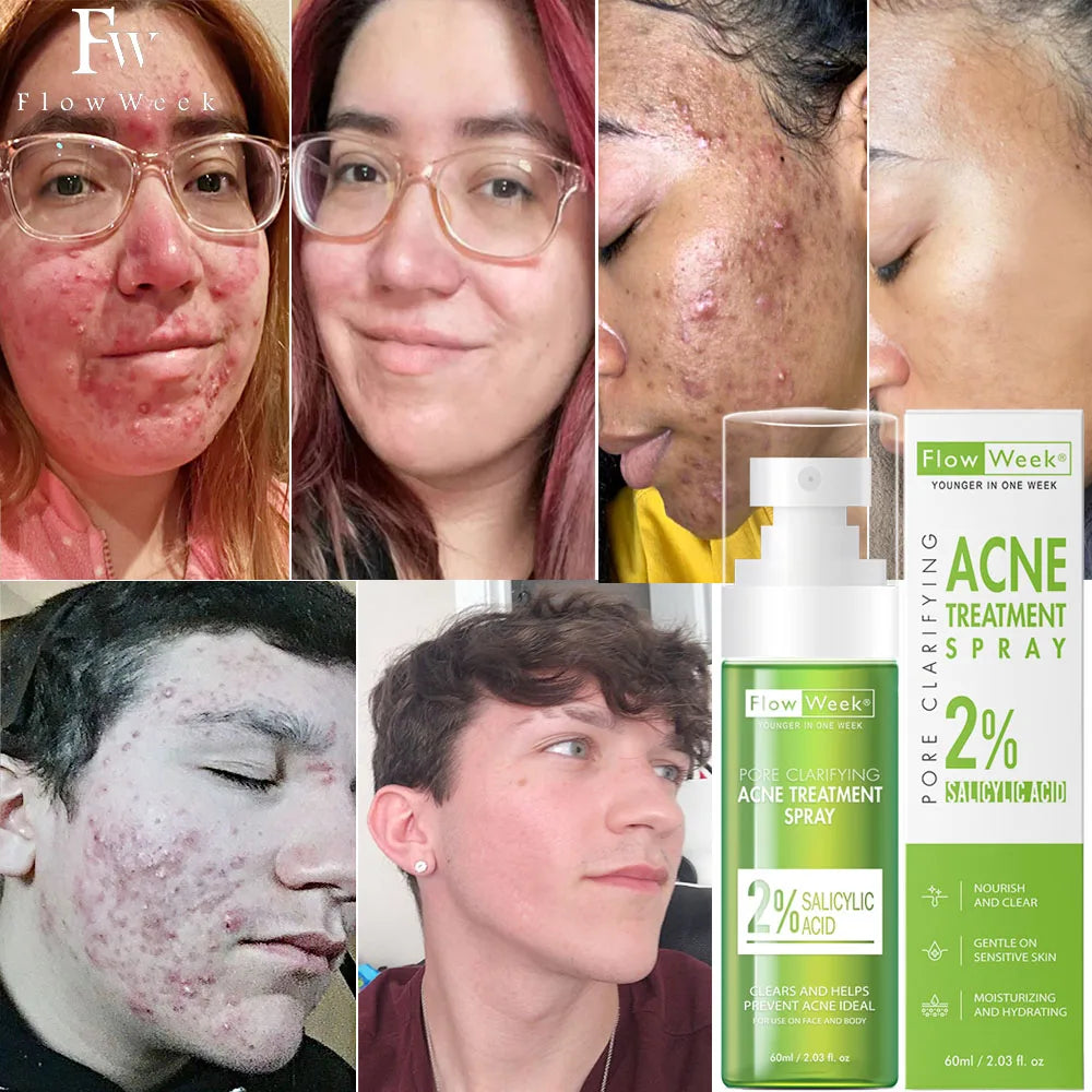 FlowWeek Salicylic Acid Acne Removal Spray,Remove Acne Cream, Back Spray, Face Body Acne Spray, Pimple Remover, Acne Treatment