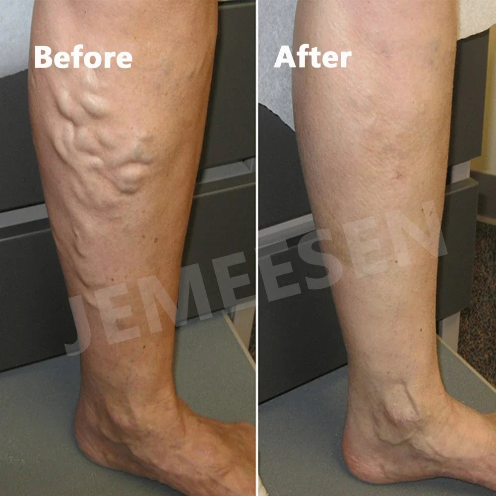 Jemeesen Potent Varicose Veins Relief Cream Leg Vasculitis Phlebitis Spider Shape Vein Pain Relief Ointment Angiitis Removal