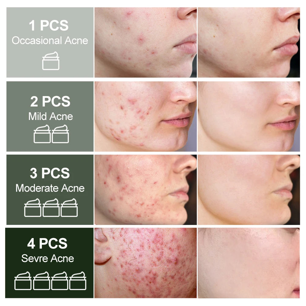 Natural Herbal Acne Treatment Face Cream Facial Pimple Scar Remove Oil control Against Acne Marks Day Creams Skin Care JoyPretty