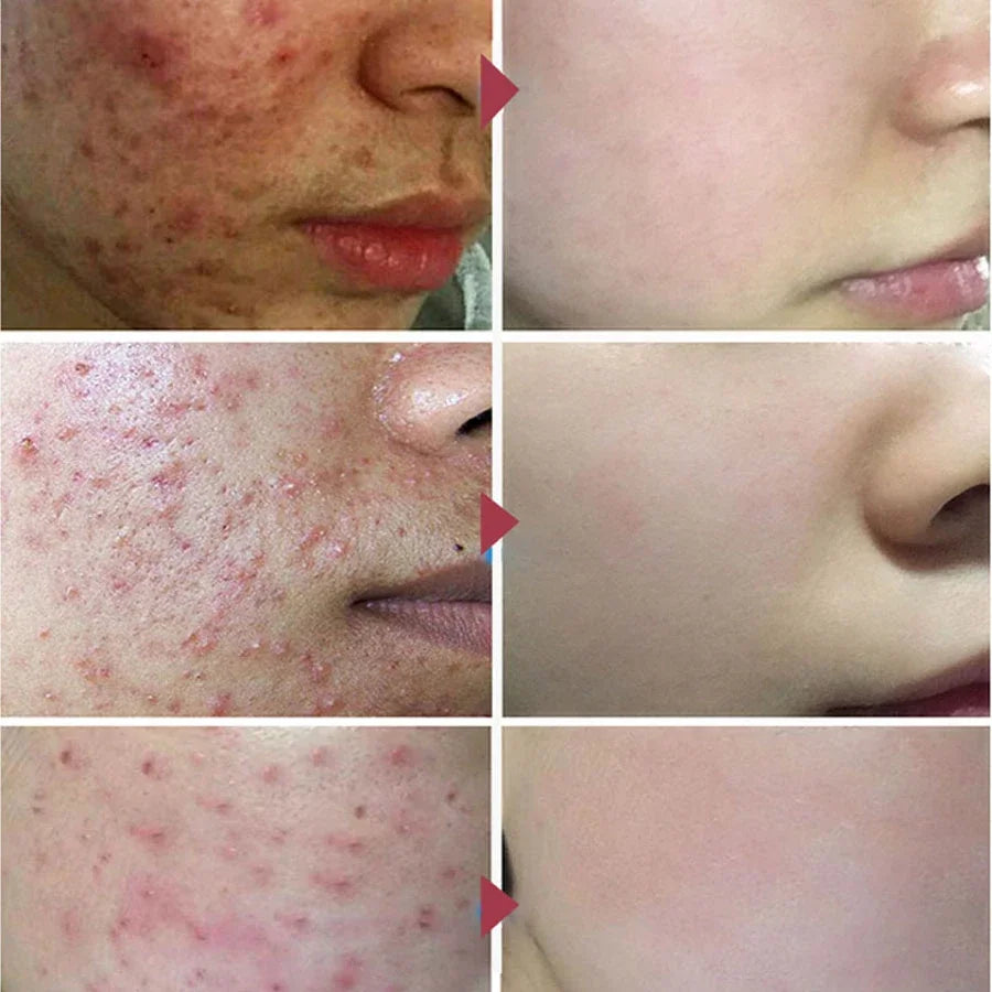 JoyPretty Herbal Acne Removal Face Cream Pimple Scar Treatment Moisturize Shrink Pore Acne Facial Cream Korean Skin Care Product