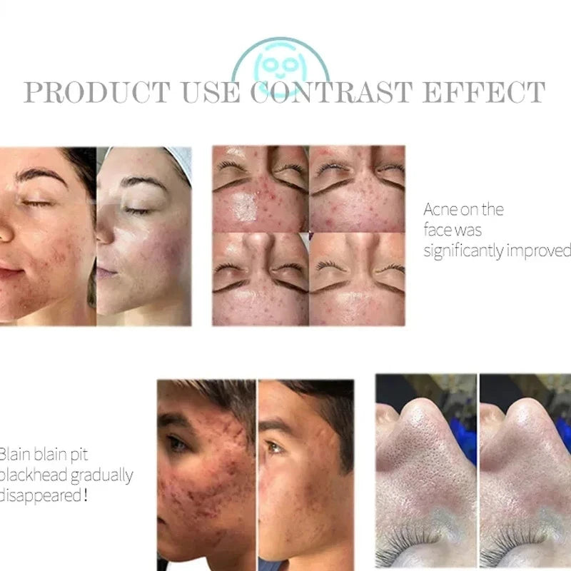 Korean NEW!!!! Professional Microdermabrasion 6 In 1 Water Oxygen Skin Care Deep Cleaning Hydra Dermabrasion Facial Machine Water Peeling