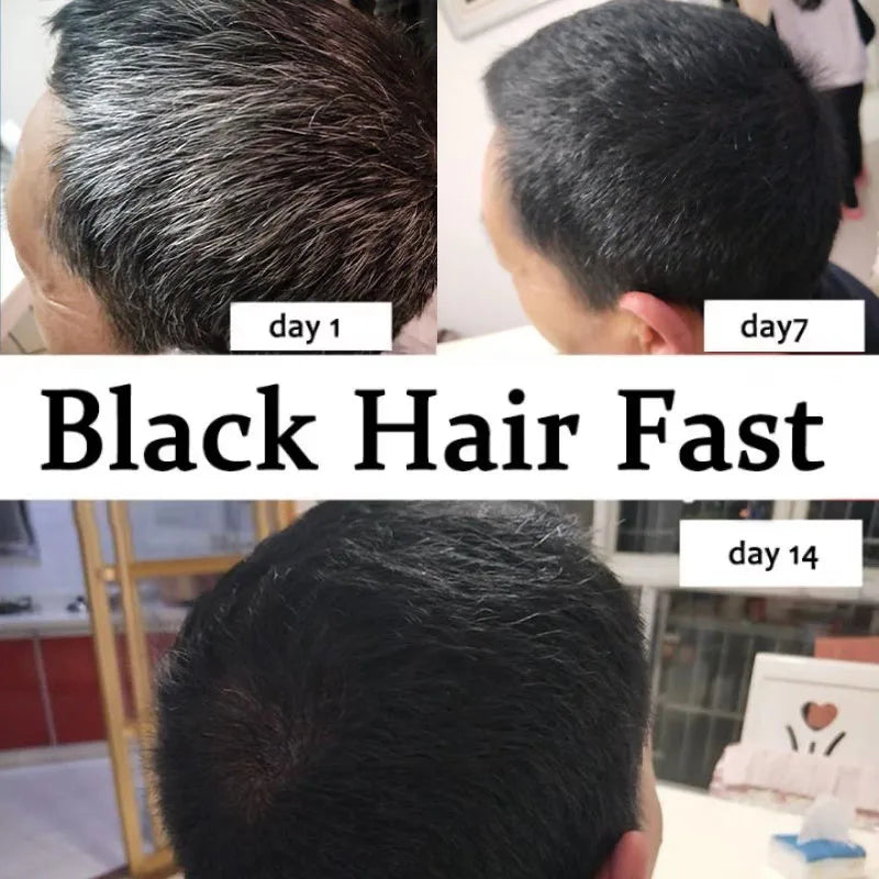 NEW Arrivals 5/10PCS Set Gray White Hair Treatment Serum Cover White Hair To Black Natural Color Repair Spray Anti Loss Hair Restore Healthy Hair Care Supplies