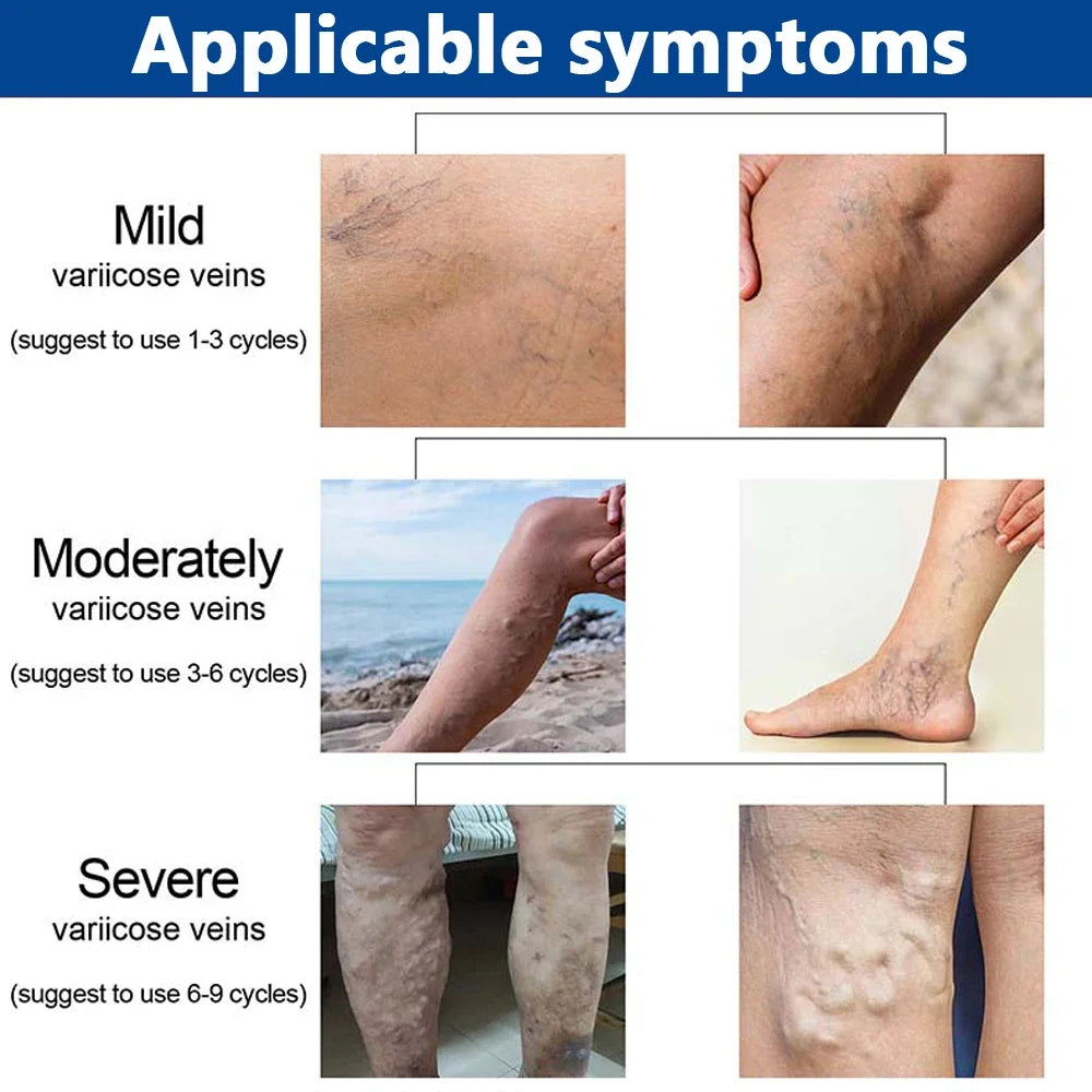 Jemeesen Potent Varicose Veins Relief Cream Leg Vasculitis Phlebitis Spider Shape Vein Pain Relief Ointment Angiitis Removal