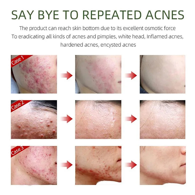 FlowWeek Salicylic Acid Acne Removal Spray,Remove Acne Cream, Back Spray, Face Body Acne Spray, Pimple Remover, Acne Treatment