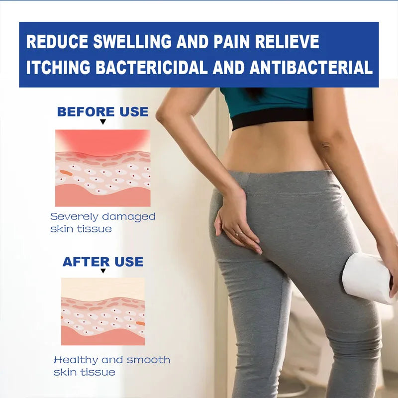 Herbal Hemorrhoid Cream Treatment Hemorrhoid Pain External Anal Fissure Relieve Anal Bleeding Swelling Ointment Beauty Health