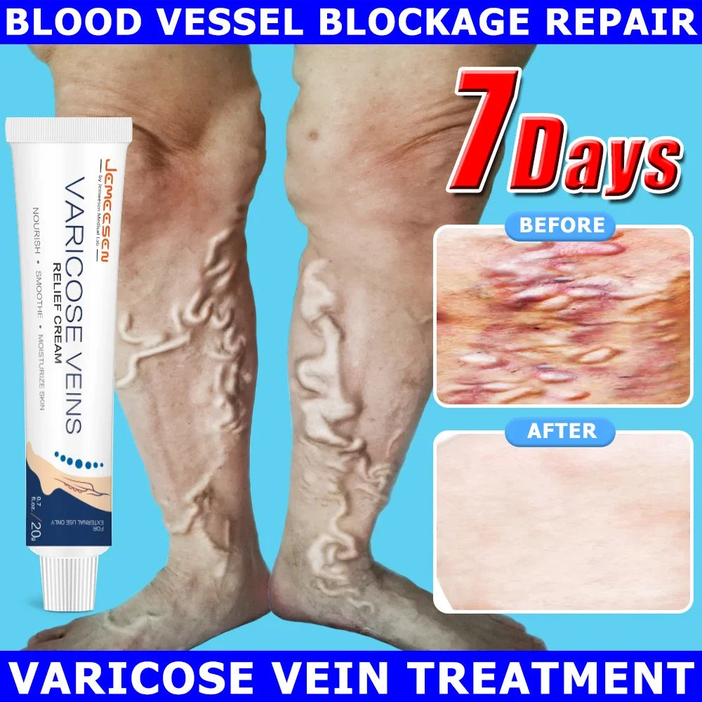 Jemeesen Potent Varicose Veins Relief Cream Leg Vasculitis Phlebitis Spider Shape Vein Pain Relief Ointment Angiitis Removal