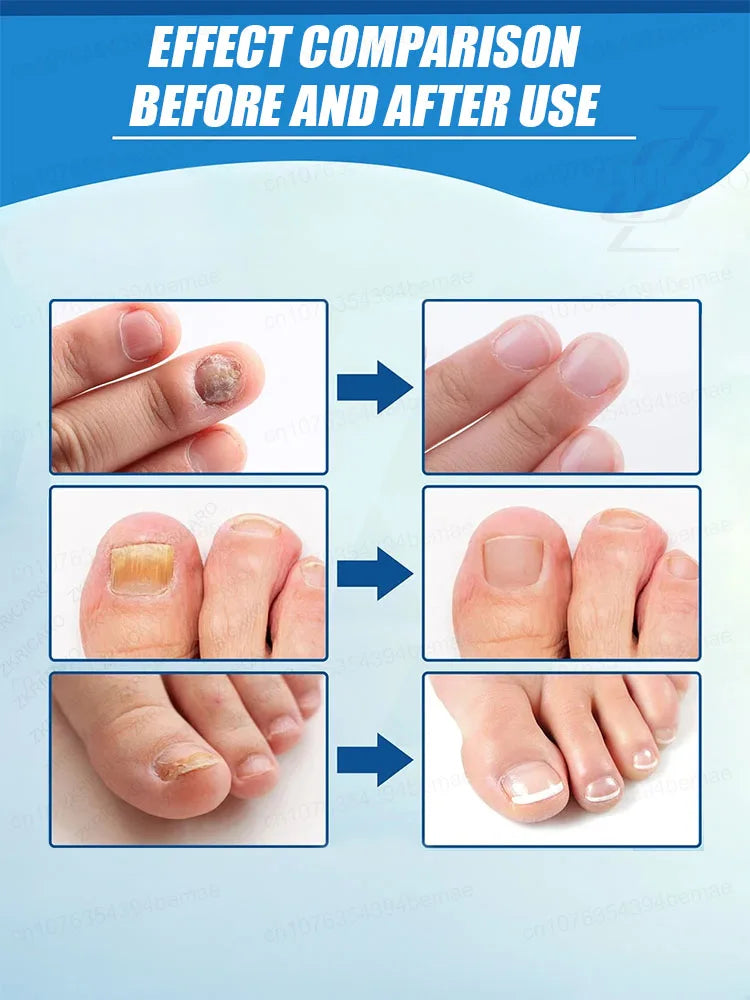 Laser Foot Nails Sterilization Onychomycosis Disinfection Therapy Treatment Armor Heart Cure Laser Device Set