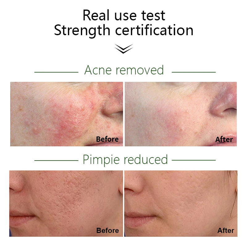 JoyPretty Herbal Acne Removal Face Cream Pimple Scar Treatment Moisturize Shrink Pore Acne Facial Cream Korean Skin Care Product