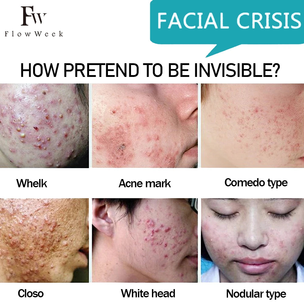 FlowWeek Salicylic Acne Face Gel Pimple for Teens Blackhead Removal Shrink Pore Oil Control Moisturizing Facial Cream Skin Care