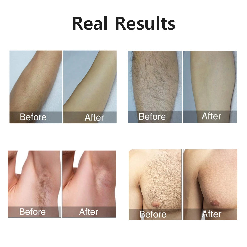 999999 Flashes Laser Epilator Hair Removal for Women Men Body Legs Armpit Painless IPL Laser Permanent Depilator
