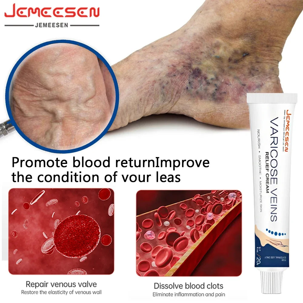 Jemeesen Potent Varicose Veins Relief Cream Leg Vasculitis Phlebitis Spider Shape Vein Pain Relief Ointment Angiitis Removal