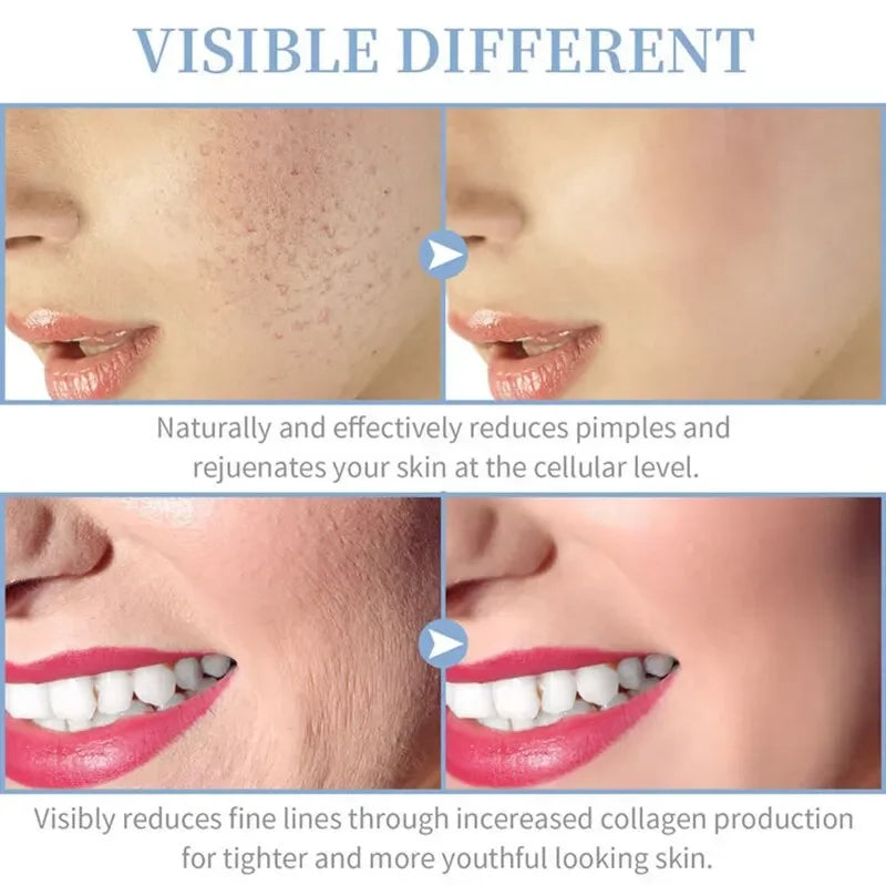 NEW 4 In 1 Set Portable Handheld High Frequency Skin Therapy Wand Machine for Acne Treatment Skin Tightening Wrinkle Reducing Women Skin Care Supplies