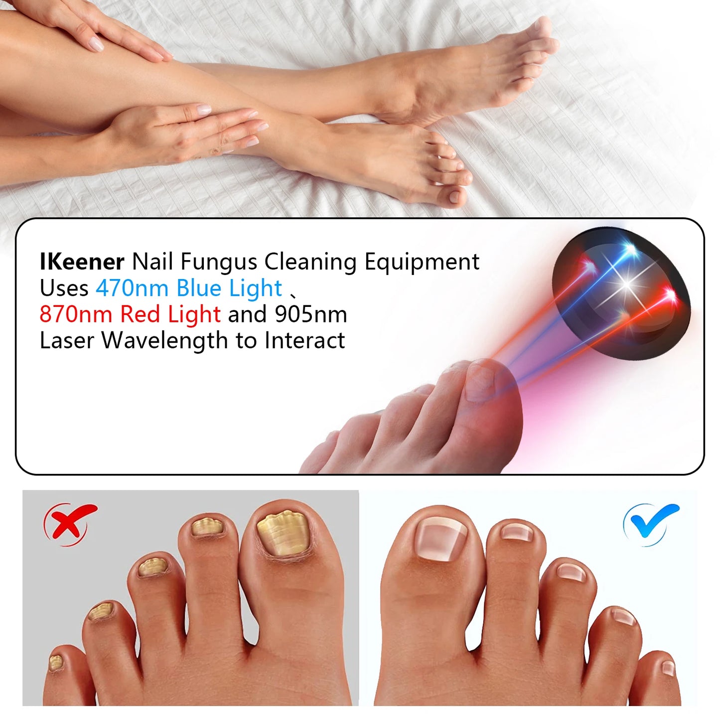 KTS Nail Fungus Laser Device Toenail Laser Therapy Machine Anti Fungal Laser Equipment for Onychomycosis 910nm 407nm USB Charge