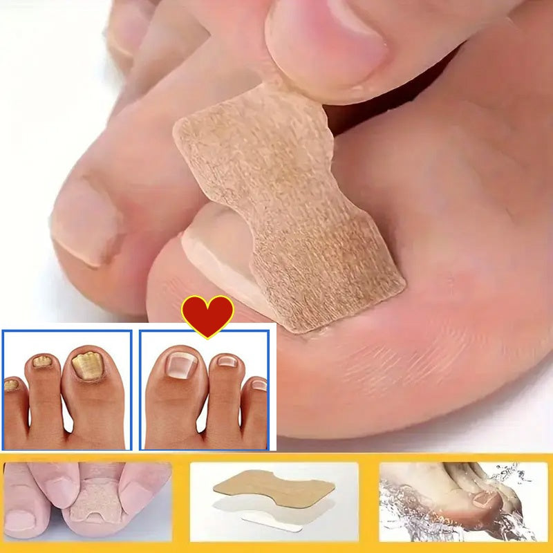 NEW Arrivals 160 PCS 16 Sheets Set Glue-On Toenail Correction Tapes - Instant Cover for Toenails, Hidden Holes & Bends, Nail Cover Strips, Easy Cut-to-Fit (No Sensitive Glue), for Sensitive Light Beige