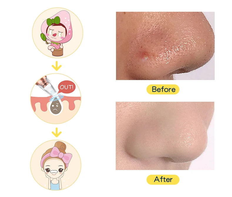 NEW Arrivals Blackhead Remover Pore Vacuum Electric Acne Extractor Kit Facial Pore Deep Cleaner USB Rechargeable Women Skin Care Tools