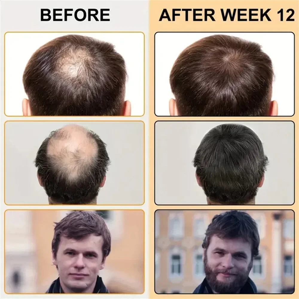 BIOTIN 1/3/5/10/22 PCS Set  fast Hair Growth Oil Products Care Scalp Massage Treatments Anti Hair Loss Effective Grow Thicker Hair Serum for Women Men Hair Care Accessories