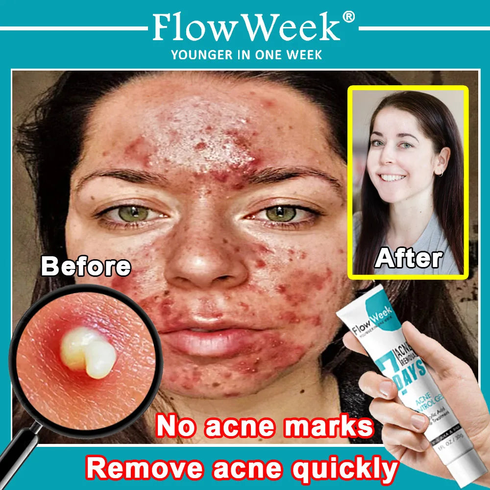 FlowWeek Salicylic Acne Face Gel Pimple for Teens Blackhead Removal Shrink Pore Oil Control Moisturizing Facial Cream Skin Care