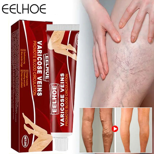 Effective Herbal Varicose Veins Relief Cream Vasculitis Phlebitis Spider Pain Relief Ointment Herb Plaster Beauty Body Care 20g