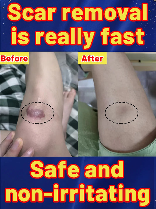 2 PCS Set Laser Pen Wound Removal is Effective for Both New and Old Wounds on the Face and Body Health Care Supplies