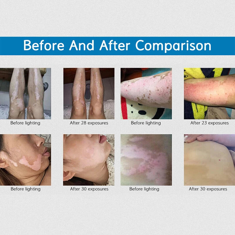 NEW 311nm UVB Treatment Instrument Vitiligo Psoriasis Skin Treatment Device Light Narrow Band Ultraviolet Phototherapy Lamps Skin Care Accessories Supplies Health Care Products