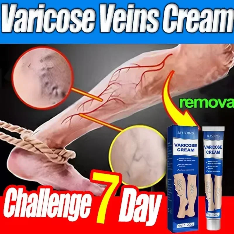 Ointment for Varicose Veins Effective Varicose Vein Relief Cream To Relieve Vasculitis Phlebitis Spider Pain Treatment Foot Care