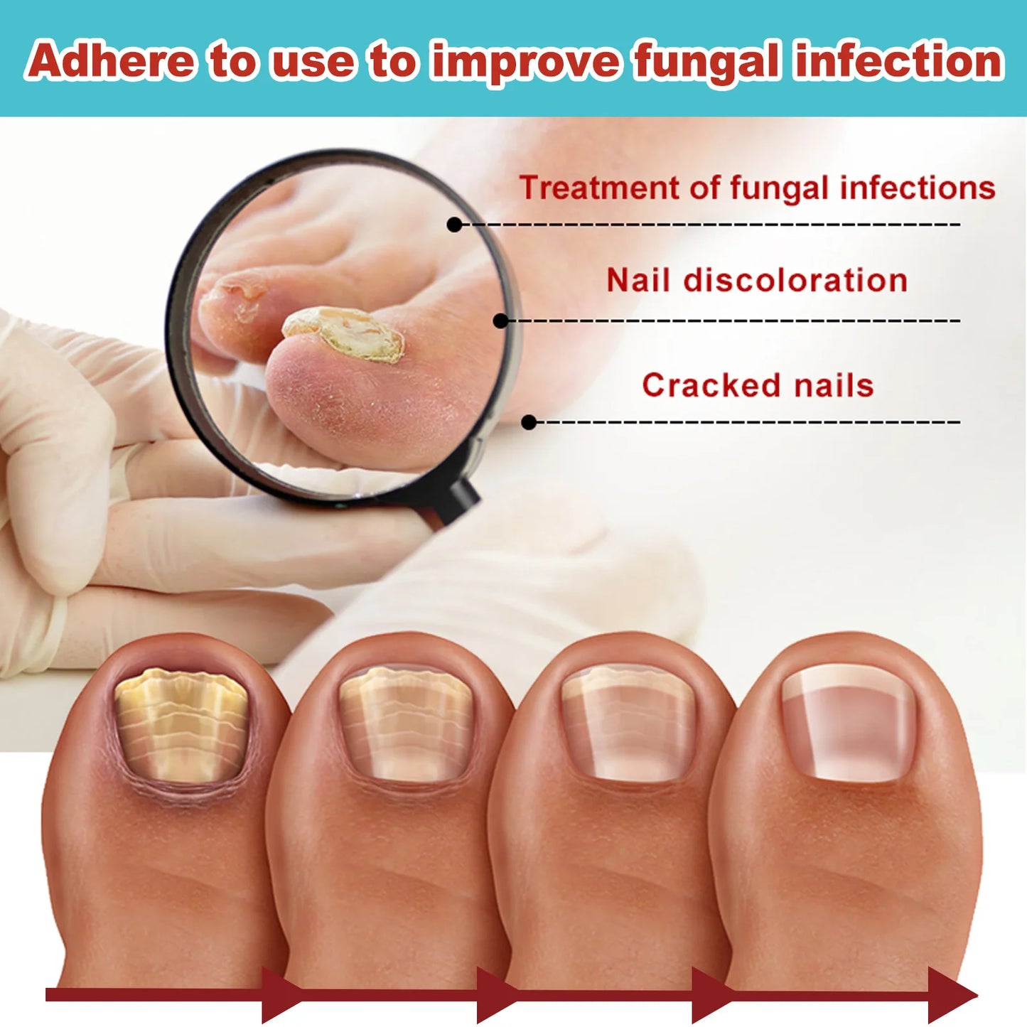 Nail Treatment Patch Anti Fungal Nail Correction Stickers Ingrown Toenail Care Paronychia Anti Infection Repair Patch
