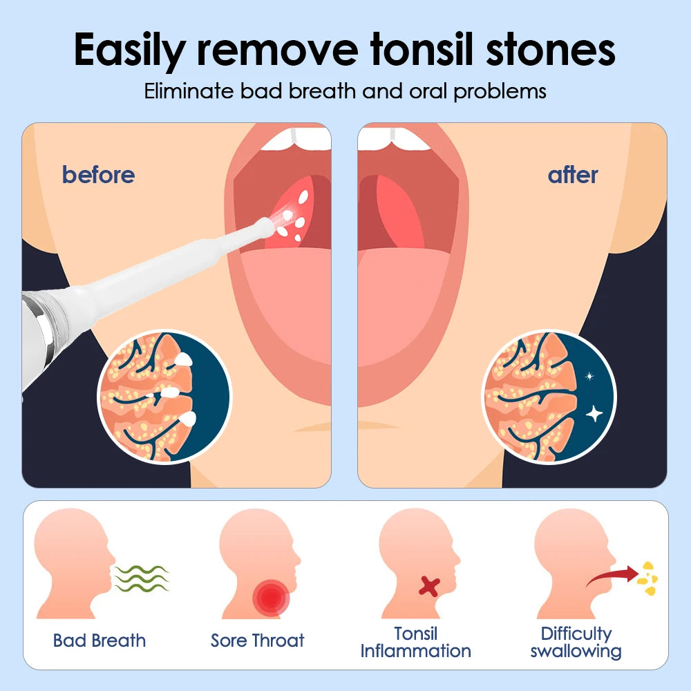 NEW Arrivals Electronic Tonsil Stone Remover LED Light Vacuum Removal Kit With Irrigation Syringe Oral Care Hygiene Accessories Instant Suction Tool Dental Devices Health Care Supplies